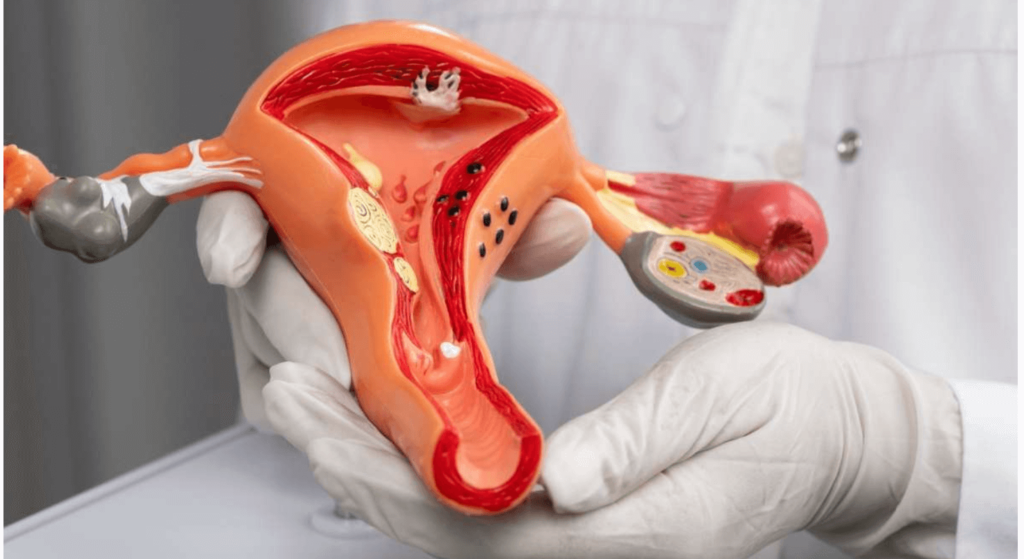 Best Gynecologist in Hyderabad: A Guide to Understanding and Managing Uterine Fibroids