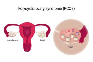 PCOS Treatment in Hyderabad